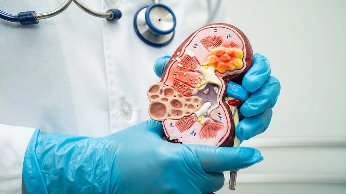 Doctor holding a model of a kidney with an infection